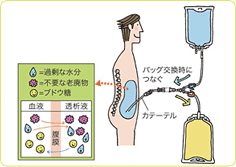 腹膜透析（PD）