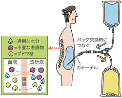 二つの透析